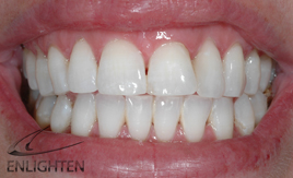Smile After Teeth whitening