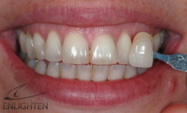 Smile Before Teeth Whitening